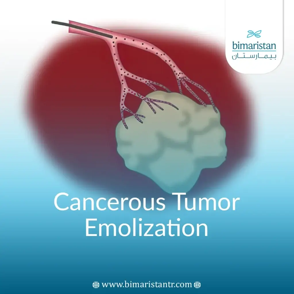 tumor embolization