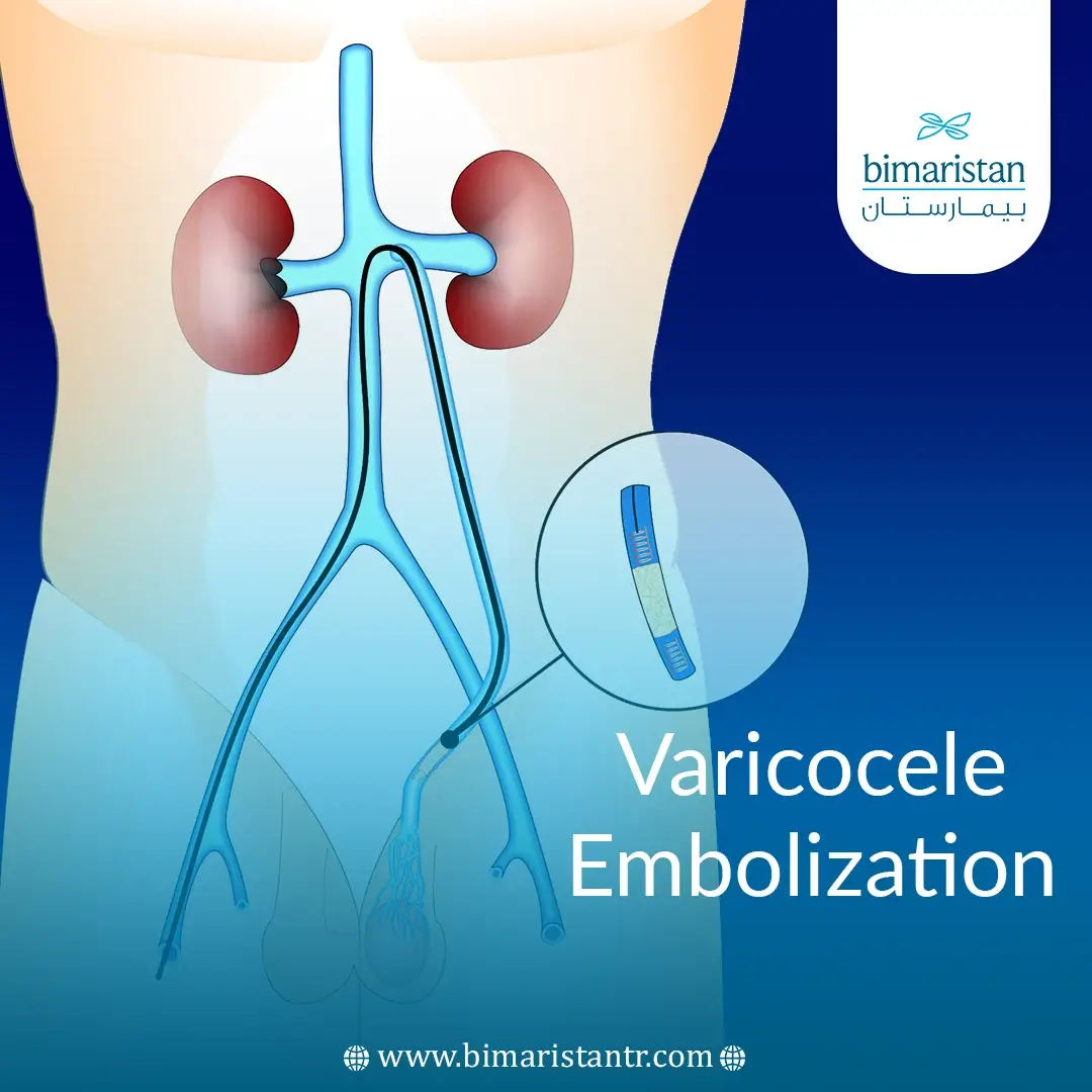 Varicocele Embolization