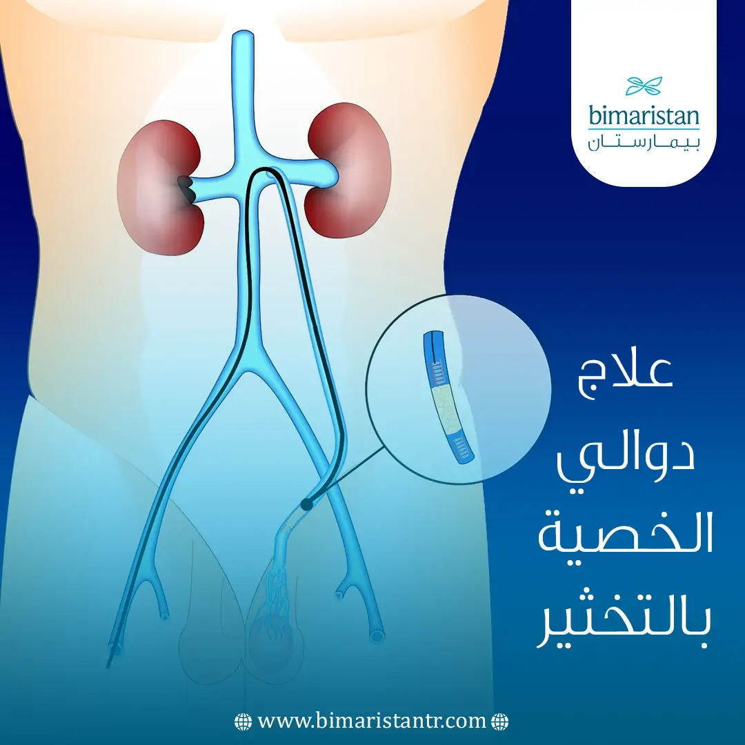 علاج دوالي الخصية بالتخثير