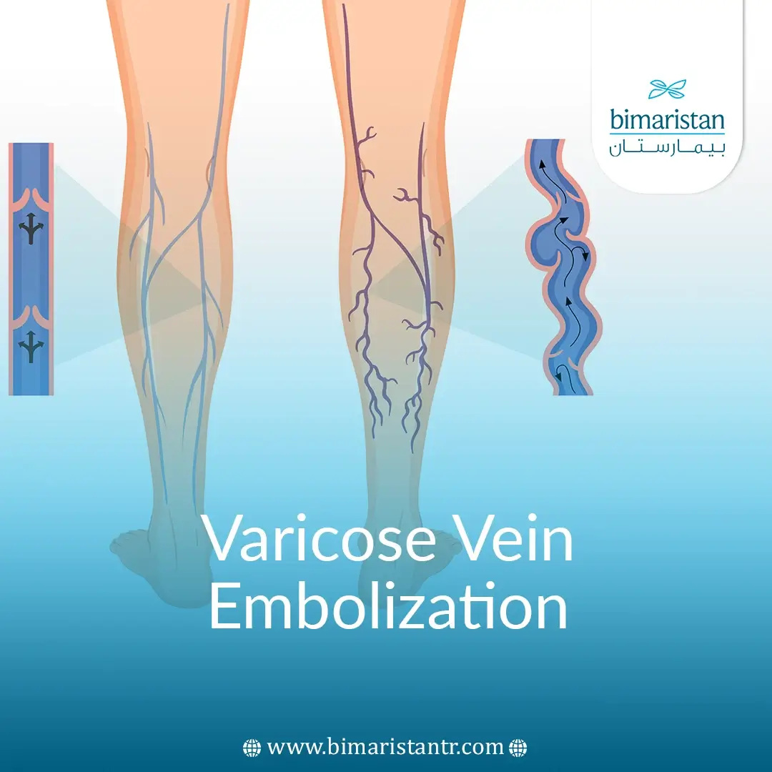 Varicose Vein Embolization