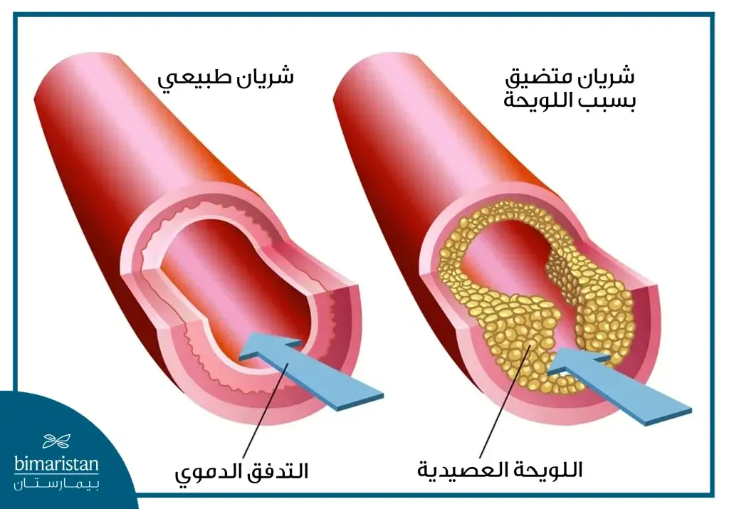 التصلب اللويحي للشرايين من أهم أسباب الذبحة الصدرية