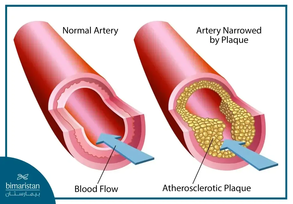 Atherosclerosis Is One Of The Main Causes Of Angina