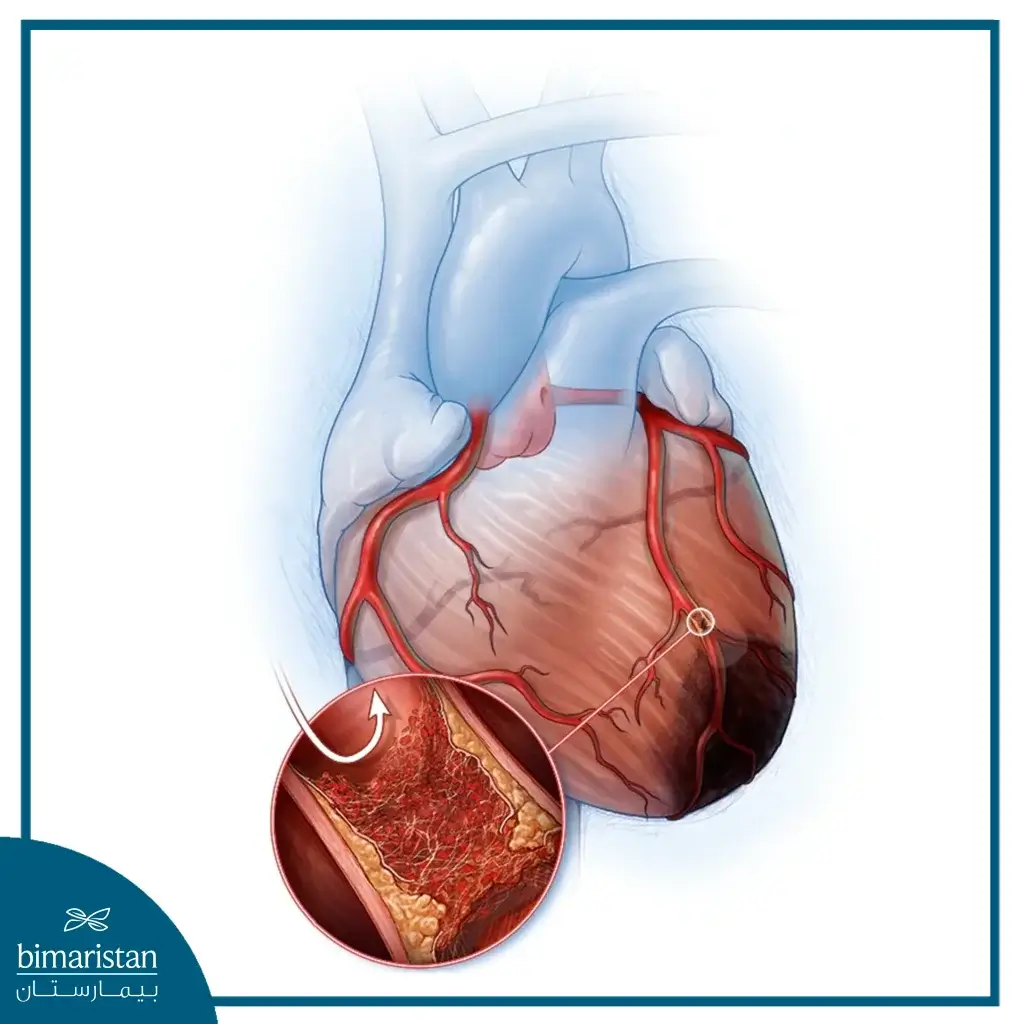 Thrombus Led To Myocardial Infarction