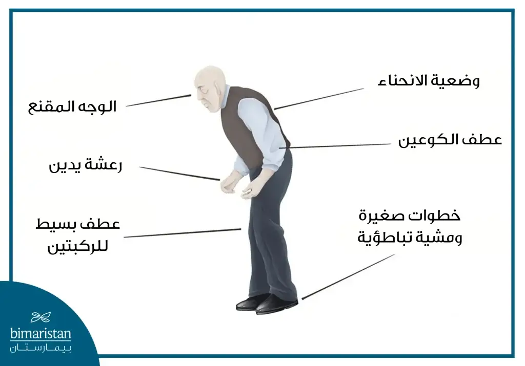 صورة توضح أعراض مرض باركنسون الحركية