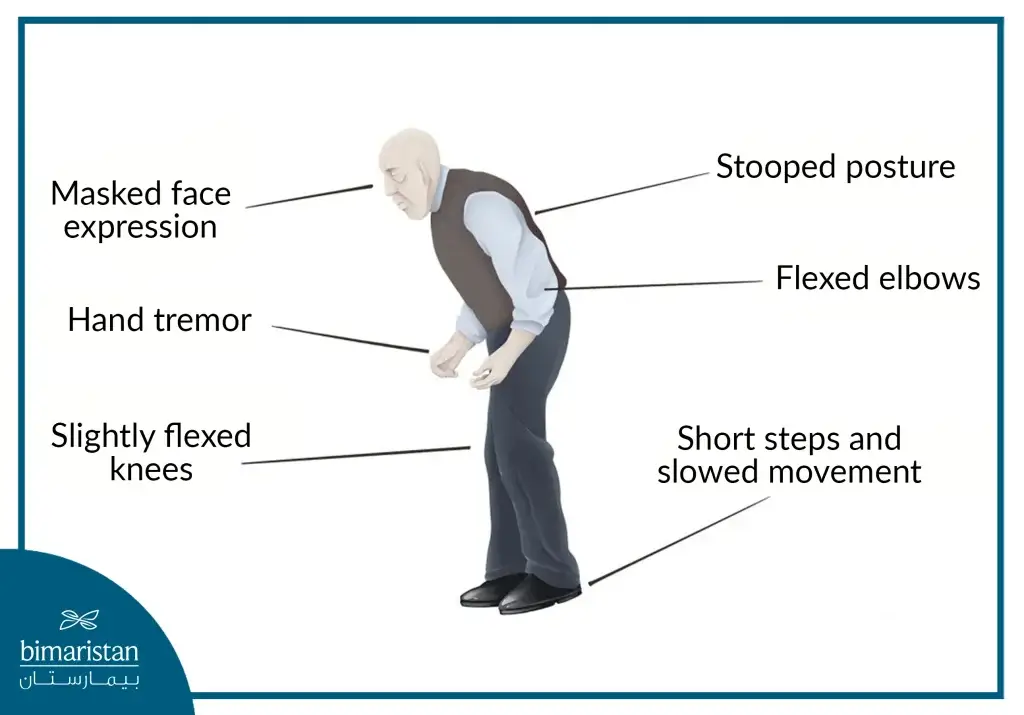 Image Showing The Motor Symptoms Of Parkinson'S Disease