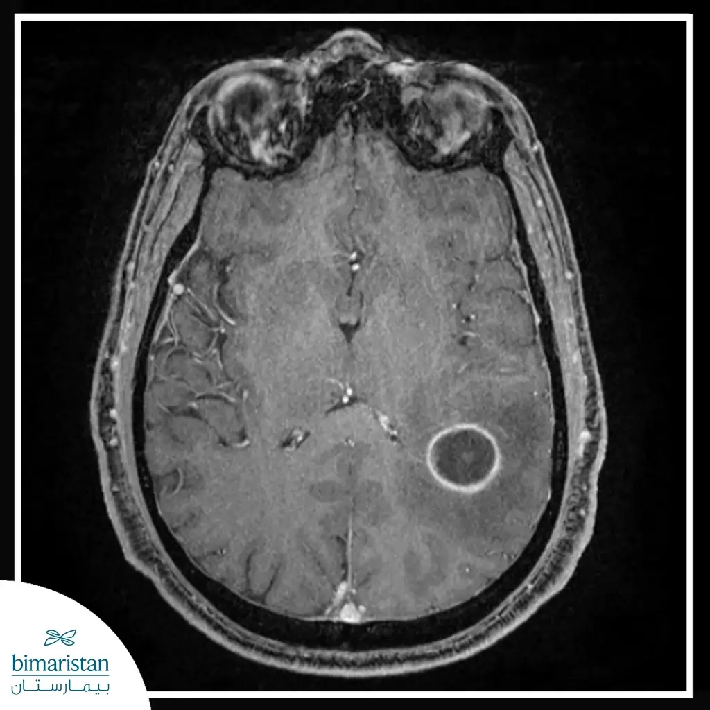 أورام الدماغ