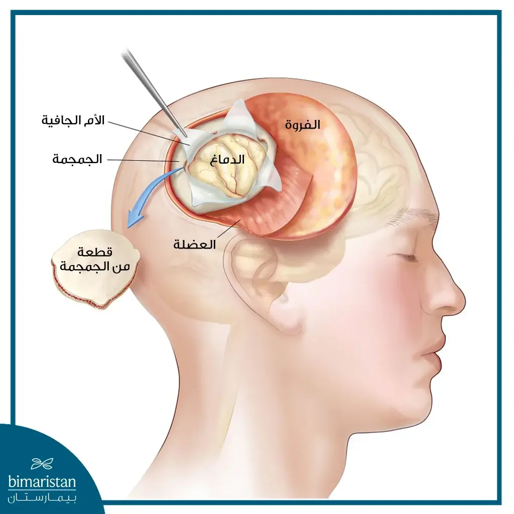 طريقة إجراء الجراحة عن طريق إزالة الطبقات الأعلى