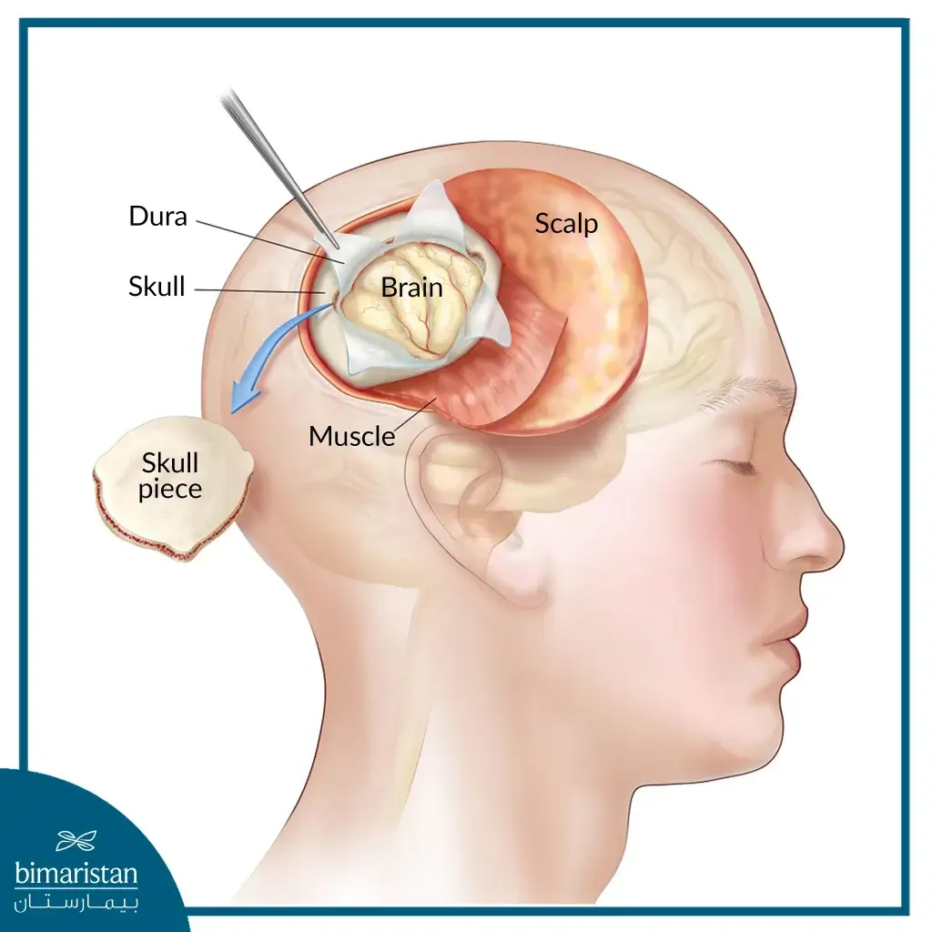 How To Perform Surgery By Removing The Upper Layers