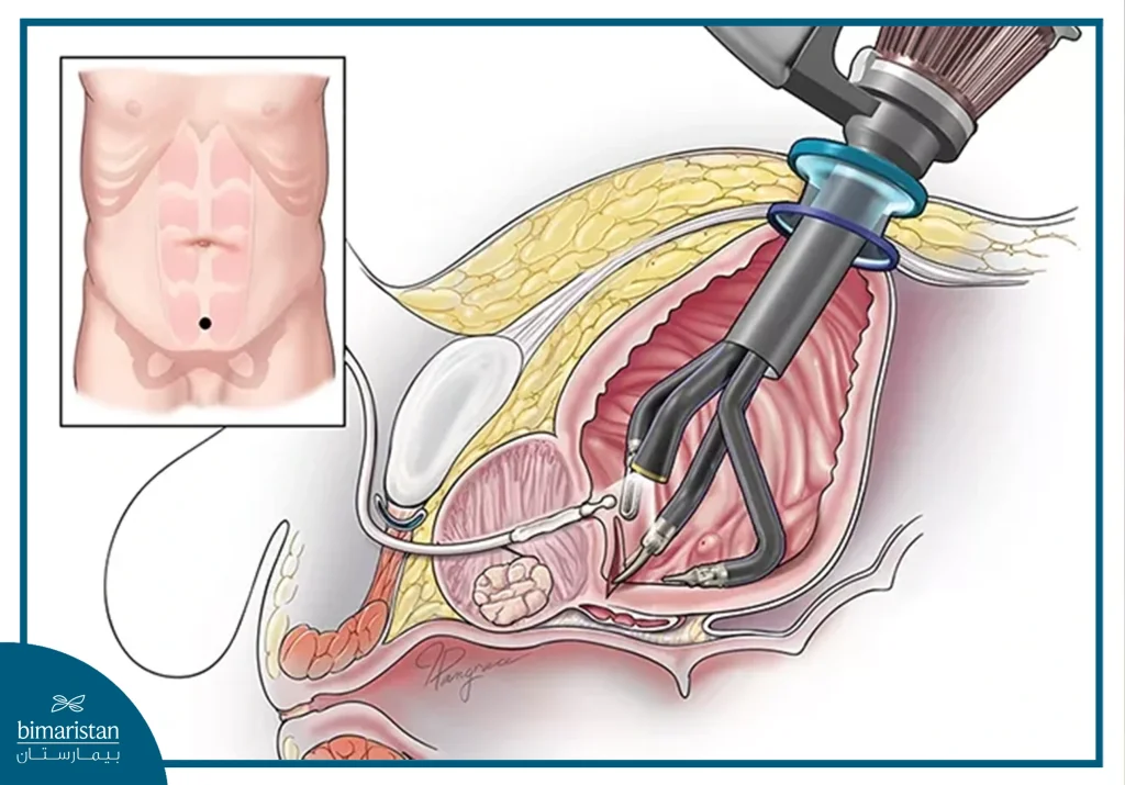 Image Showing Robotic Prostatectomy