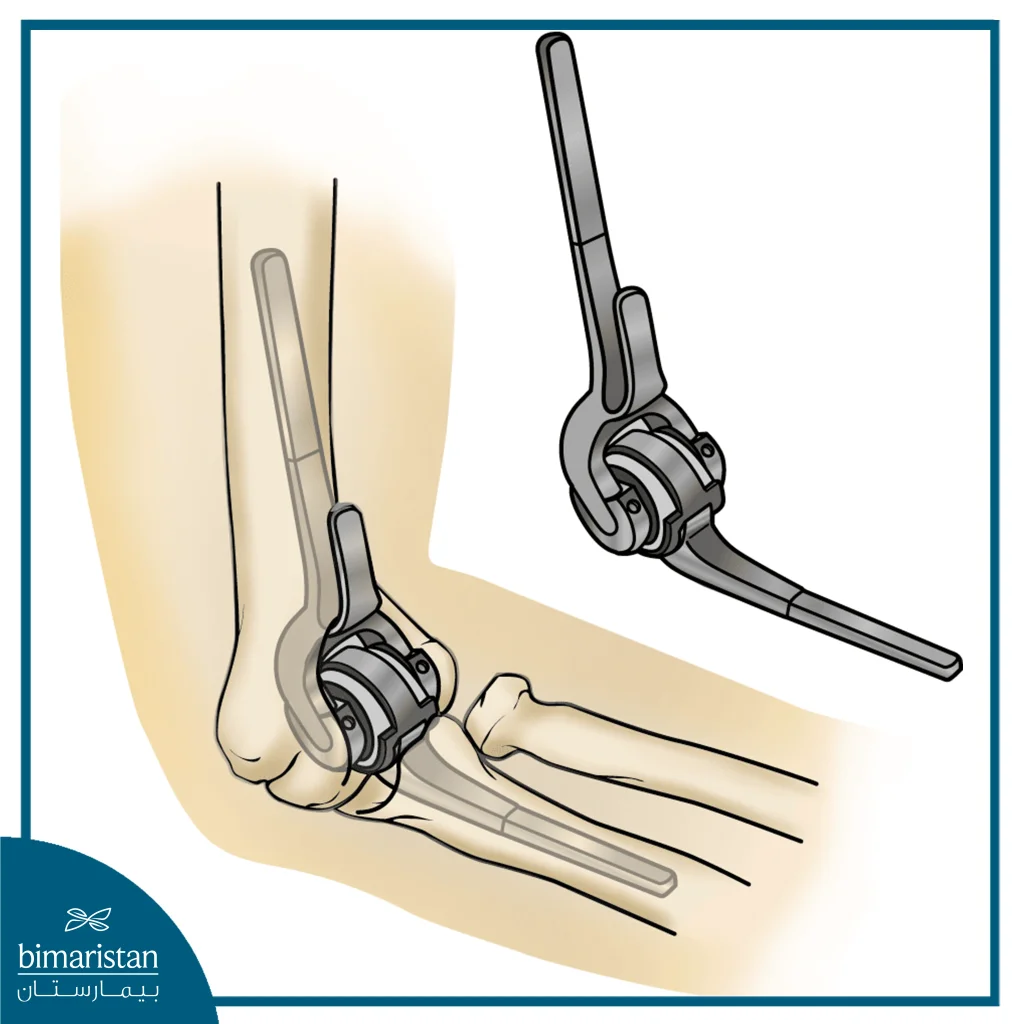 Joint Requiring Elbow Replacement Surgery