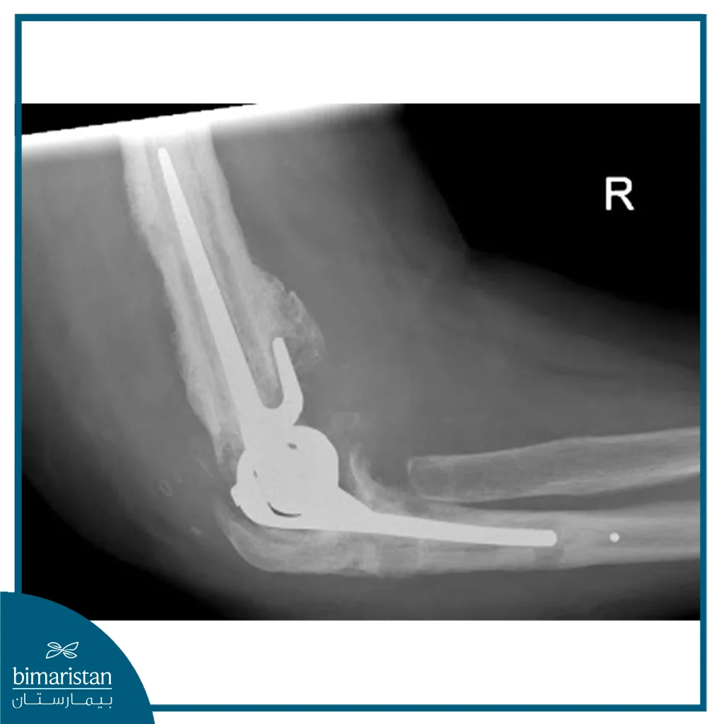 Elbow Replacement In X-Ray