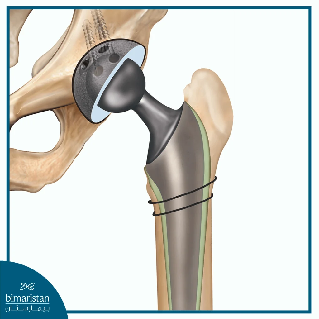 Components Of The Hip Joint In Hip Replacement: The Acetabular Component And The Femoral Component.