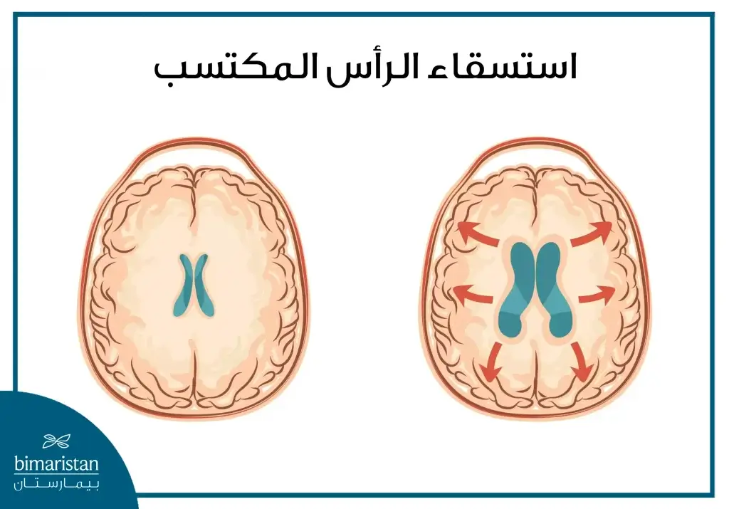 استسقاء الرأس المكتسب والذي يحصل بعد الولادة نتيجة أسباب مختلفة تمنع تصريف السائل الدماغي الشوكي
