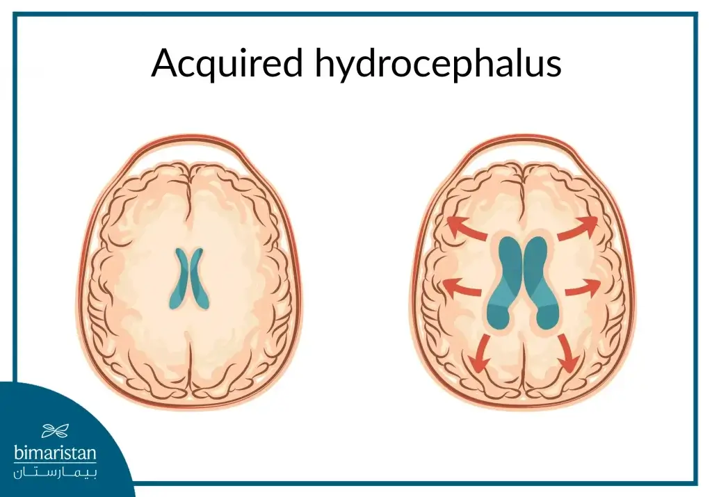 Acquired Hydrocephalus, Which Occurs After Birth As A Result Of Various Causes That Prevent The Drainage Of Cerebrospinal Fluid