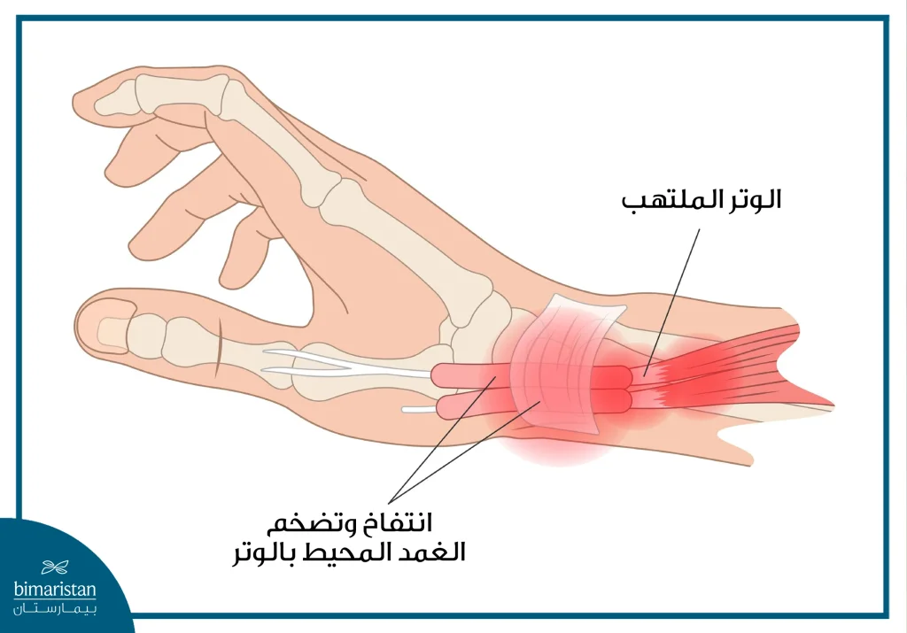 صورة توضح حالة التهاب أوتار اليد والتي غالبًا ما تنتج عن فرط استخدام اليدين