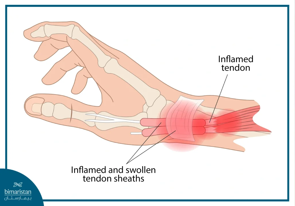 Image Showing A Condition Called Hand Tendonitis, Which Is Often Caused By Overuse Of The Hands