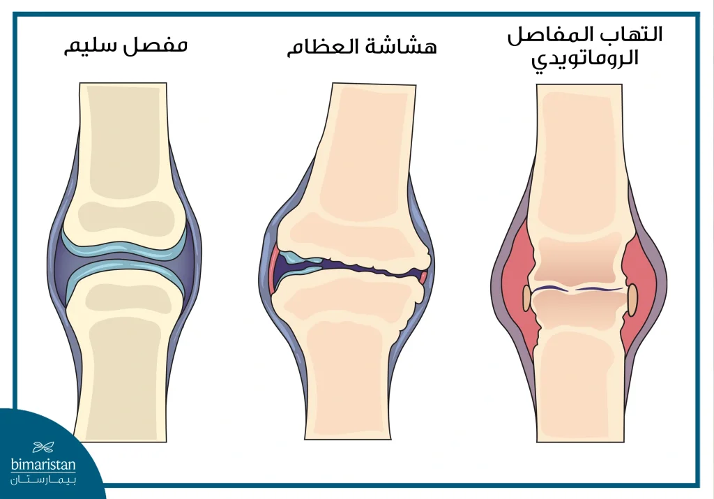 أنواع التهاب المفاصل