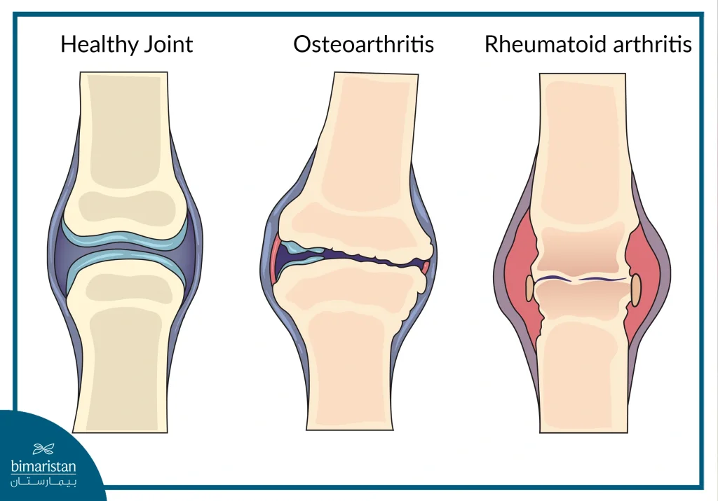 Types Of Arthritis