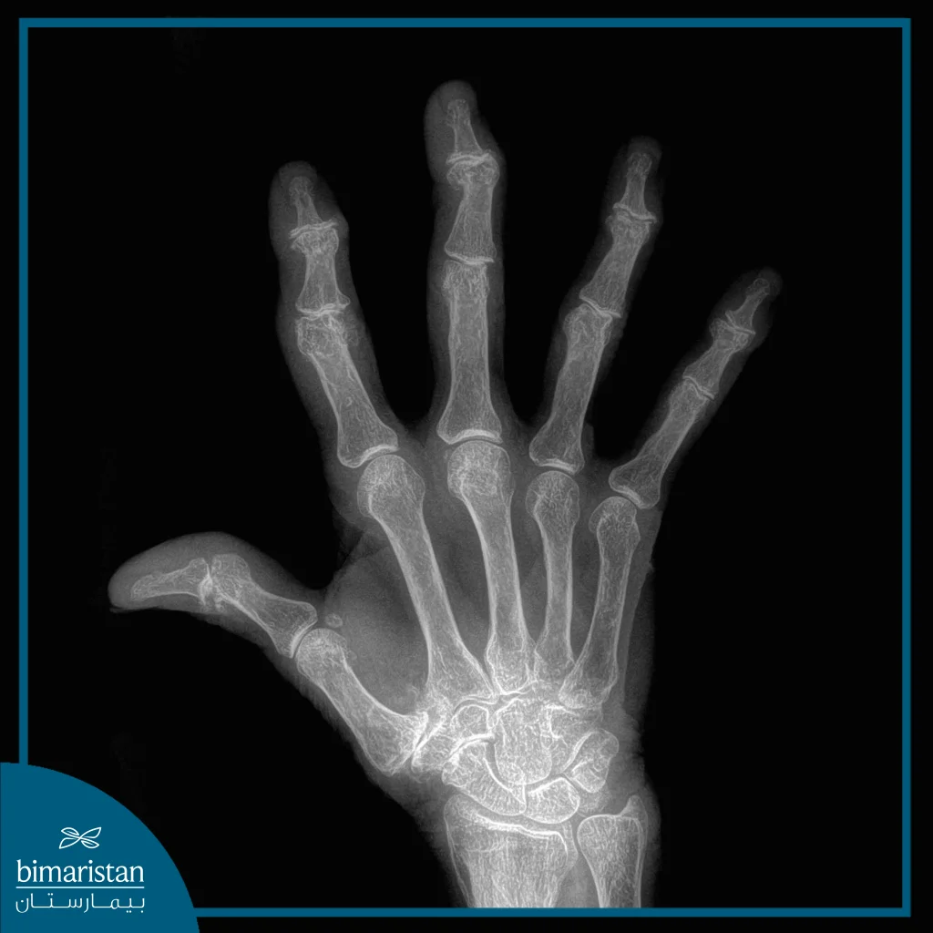 Hand Arthritis In X-Ray