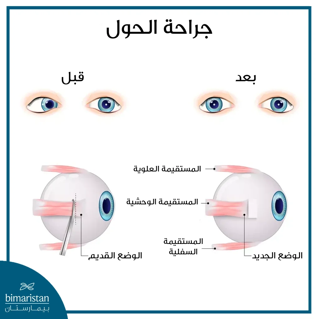 قبل وبعد جراحة الحول