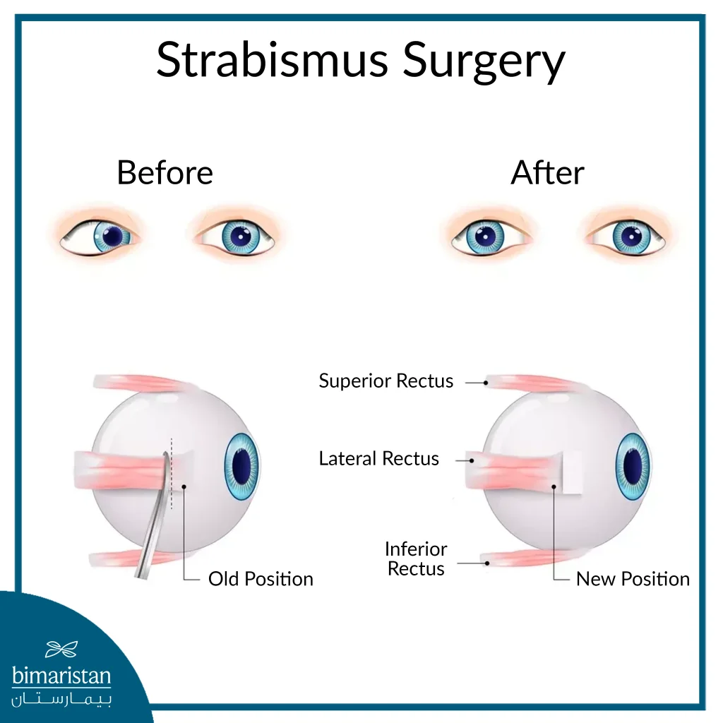 Strabismus Causes, Types And Treatment 4 Before And After Strabismus Surgery
