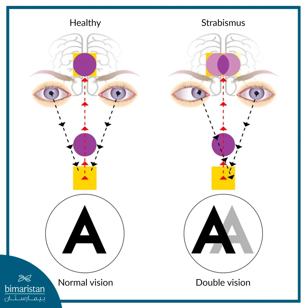 Strabismus Causes, Types And Treatment 3 Normally, The Eyes Focus On The Same Point, But In Strabismus, The Eyes Focus On Two Different Points.
