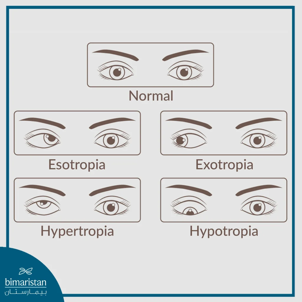 Strabismus Causes, Types And Treatment 2 Image Showing Types Of Strabismus
