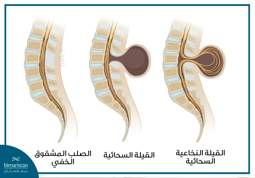 أنواع الصلب المشقوق وفقاً للمحتويات الخارجة عبر الانشقاق