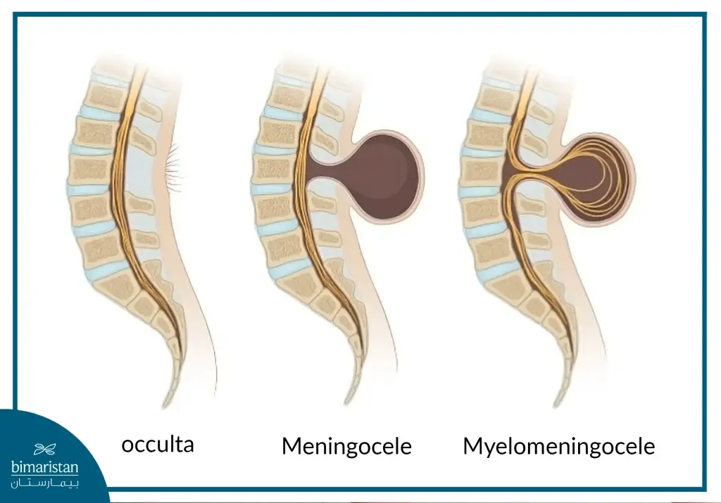 Types Of Spina Bifida According To The Contents Emerging From Cleavage