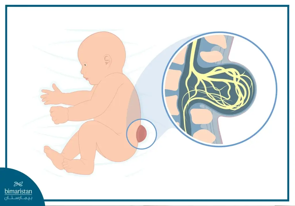 A Child With Spina Bifida Who May Need Spina Bifida Surgery