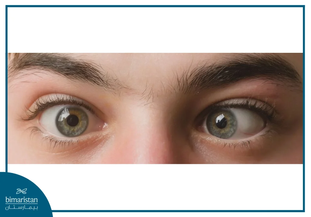 A Case Of Strabismus In The Right Eye