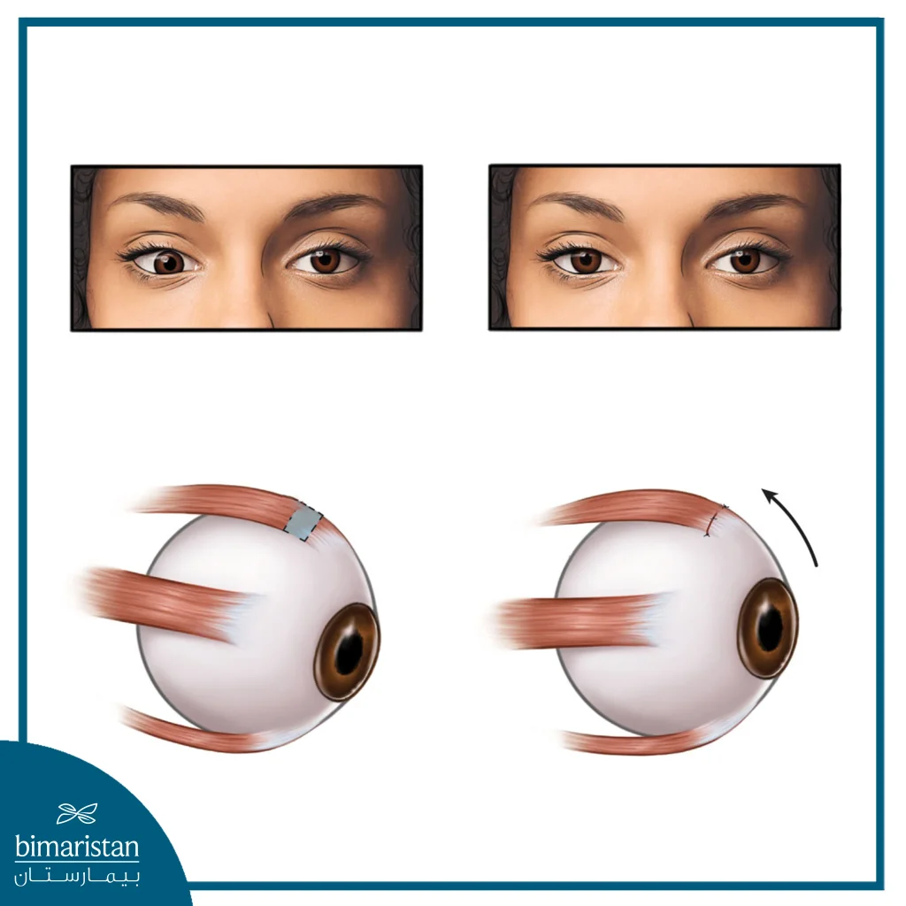 Before And After Amblyopia In Adults (Lazy Eye)