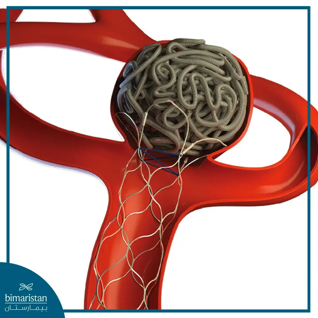 Endovascular Coiling