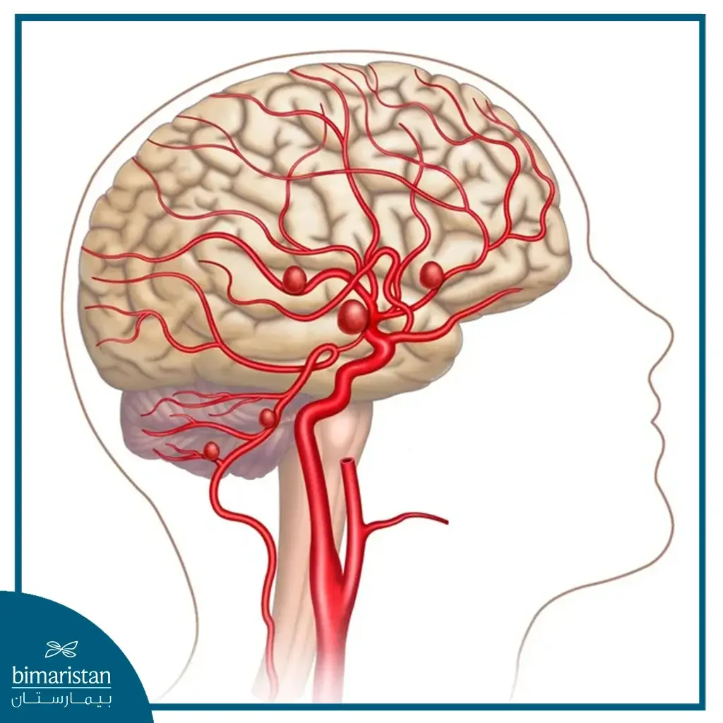 Image Showing A Bulging Blood Vessel In The Brain