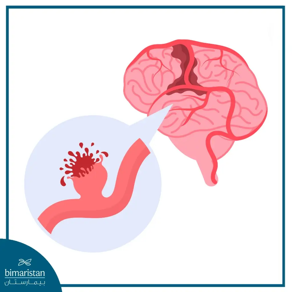 Image Showing Aneurysms And Their Rupture In Some Cases