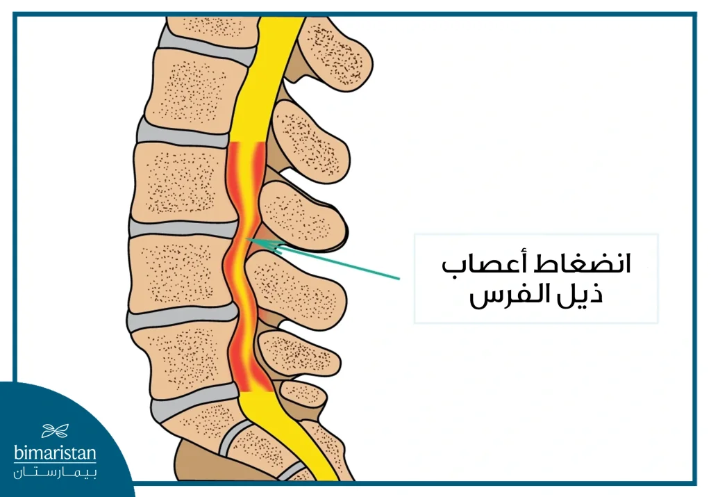 تضيق القناة الشوكية القطنية مسبباً انضغاط أعصاب ذيل الفرس