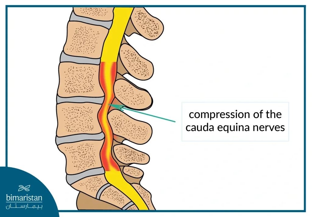 Lumbar Spinal Stenosis Causing Compression Of The Cauda Equina Nerves