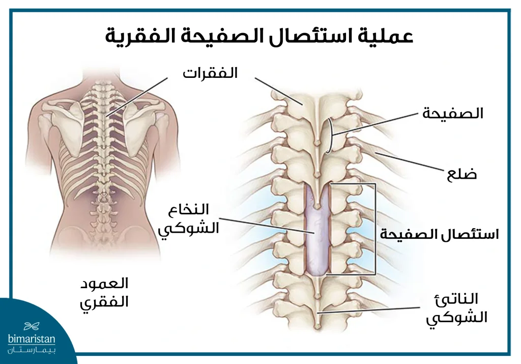 تجرى عملية استئصال الصفيحة الفقرية في تركيا من أجل تخفيف الضغط على الحبل الشوكي