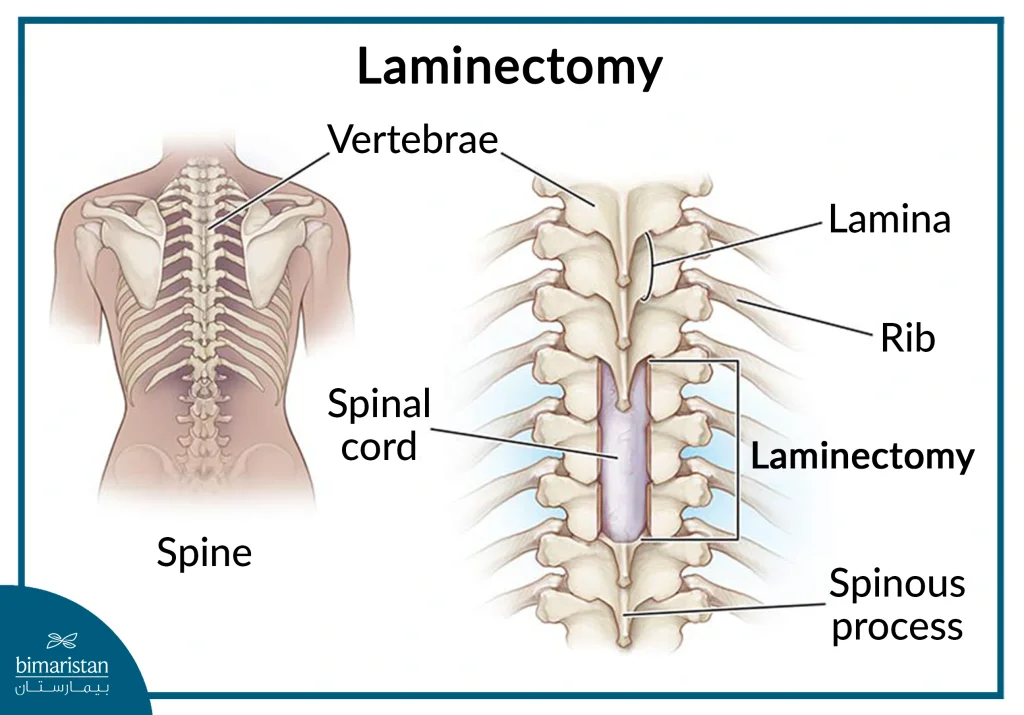 Laminectomy Is Performed In Turkey To Relieve Pressure On The Spinal Cord