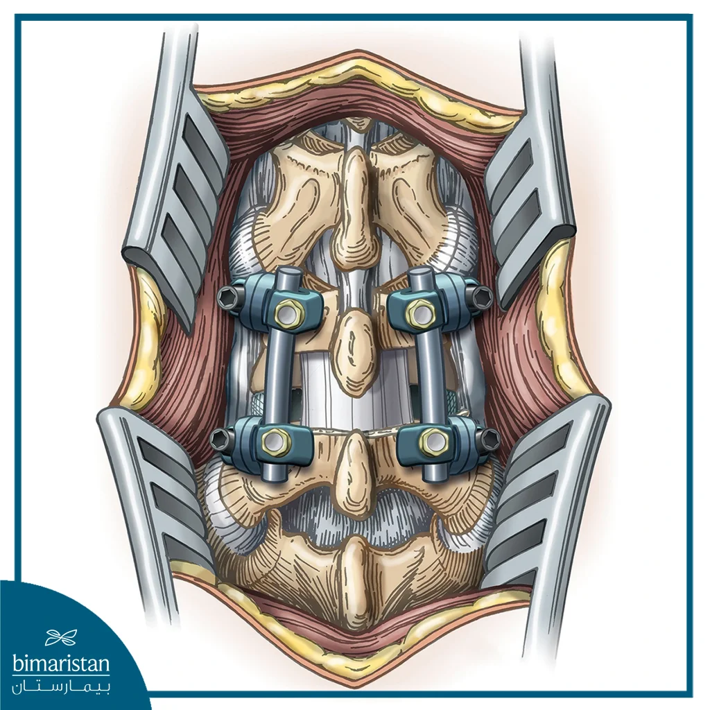 Two Consecutive Vertebrae Are Fused Together By Removing The Lamina, Installing Wires And Screws, And Replacing The Flexible Intervertebral Disc With A Fixed Graft