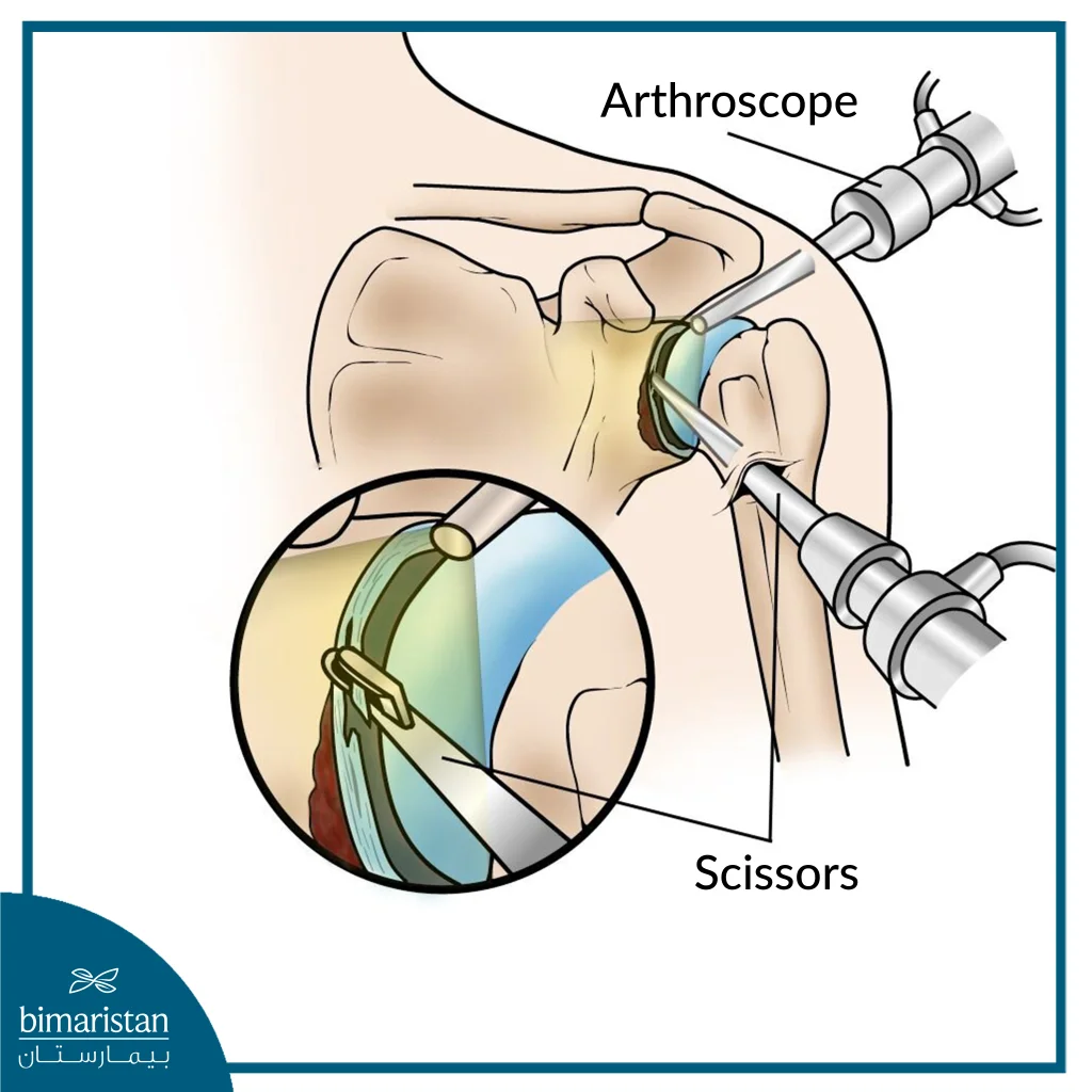 This Image Shows The Difference Between Arthroscopic Shoulder Dislocation And Open Surgery.