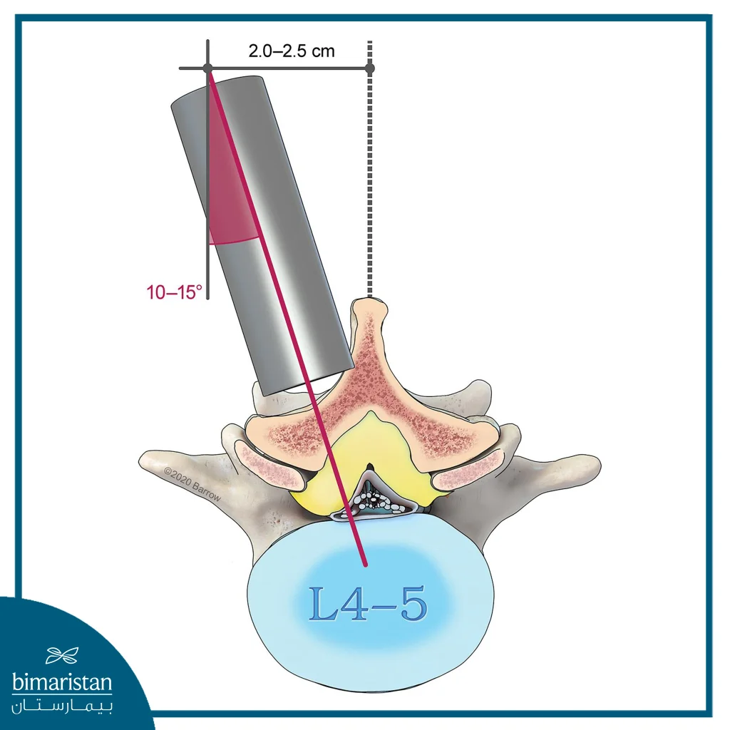 Slipped Disc (Disc) Before Microdiscectomy