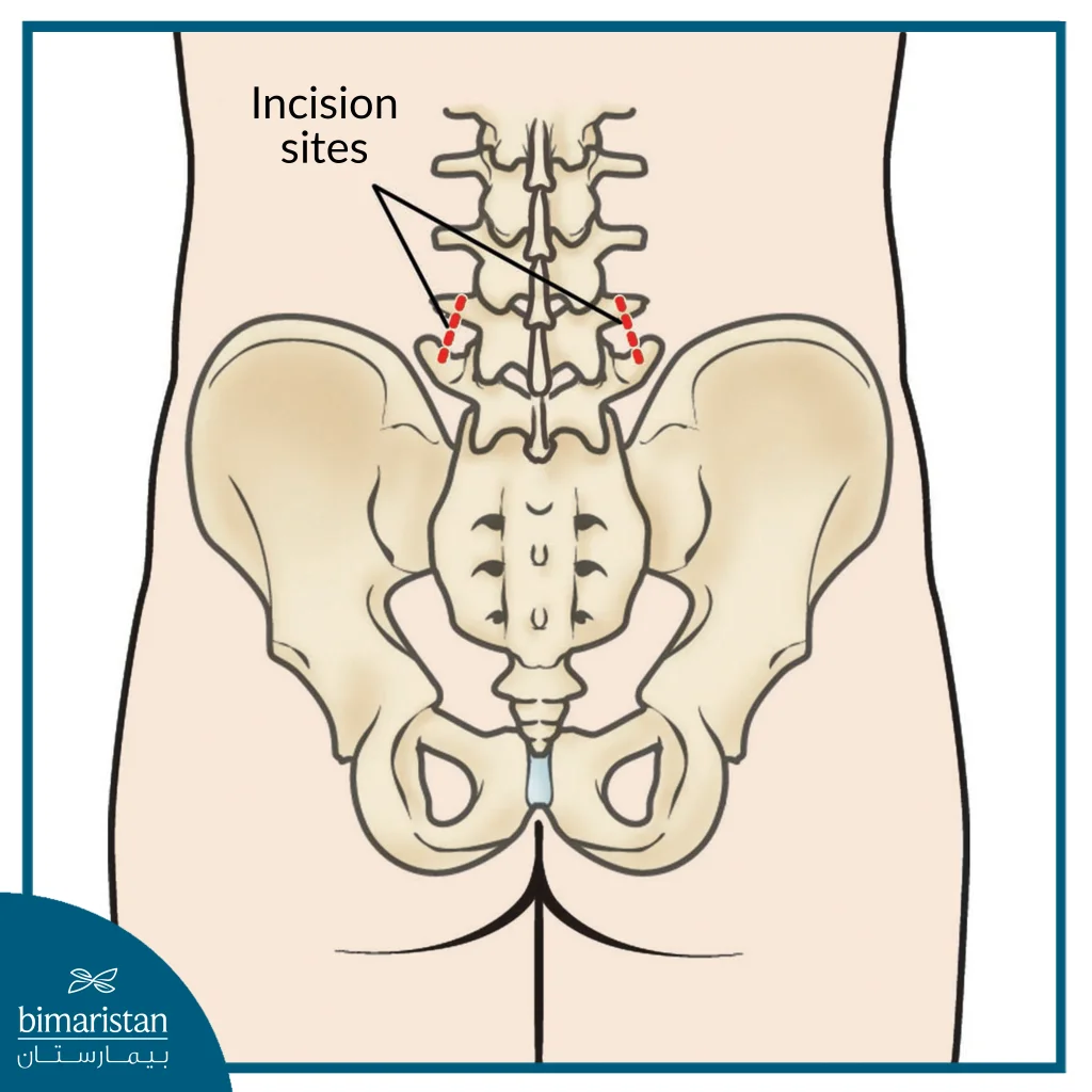 Shape And Location Of The Incision For Microdiscectomy