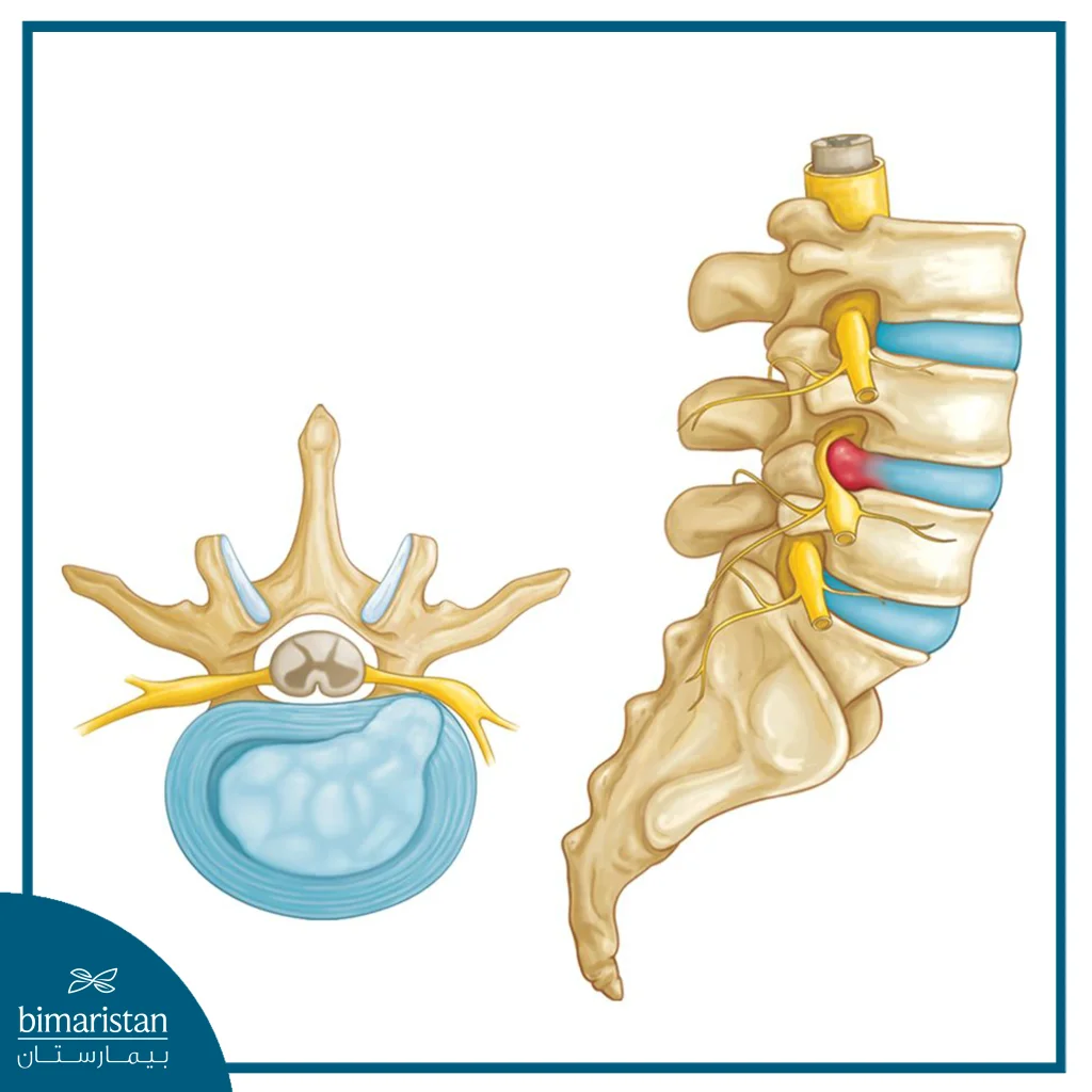 Image Showing The Removal Of A Herniated Disc With Forceps Under Microscope