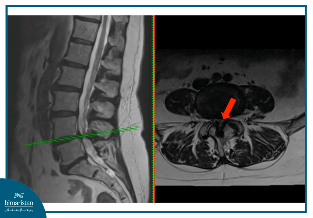 Mri Image Of Spinal Stenosis For Spinal Stenosis Surgery