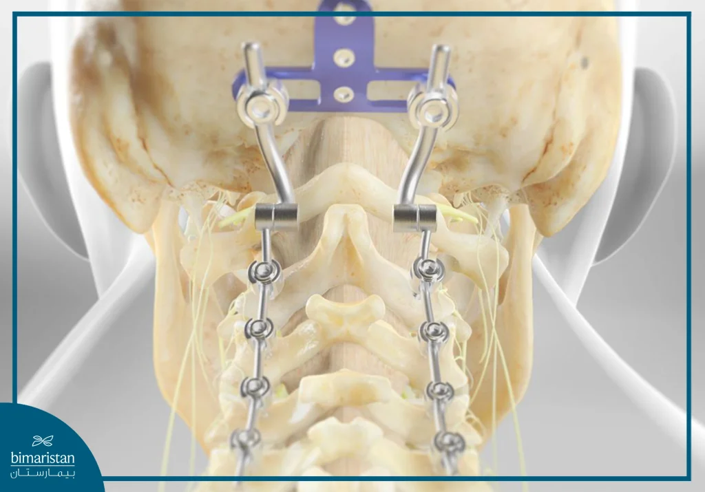 Stabilization Of The Spine Using Plates And Structures