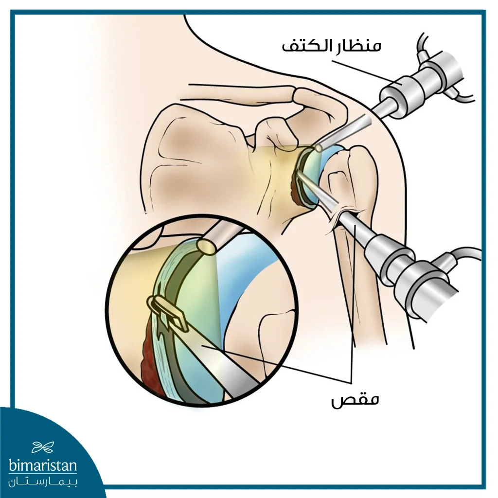 توضح هذه الصورة الفرق بين عملية خلع الكتف بالمنظار وبين الجراحة المفتوحة