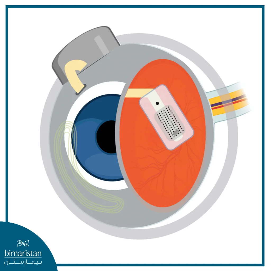 Image Showing The Artificial Retinal Implant Device (Bioelectronic Eye Implant)