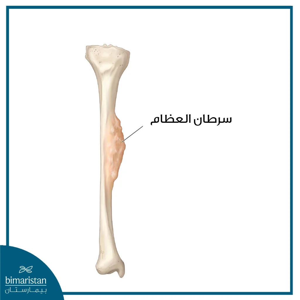 علاج سرطان العظم