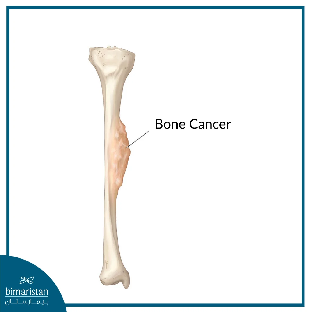 Bone Tumors